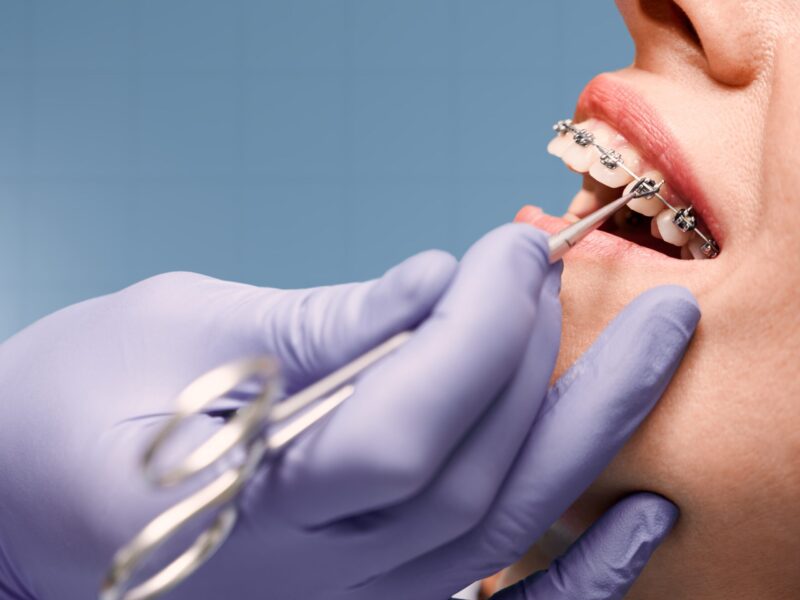 Orthodontics for Children Issaquah