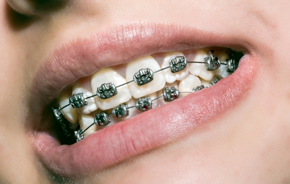 Traditional Braces for Kids Issaquah